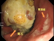 男子山楂和栗子一起吃 胃里长出8厘米石头