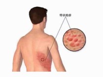 带状疱疹增加心肌梗塞发作风险