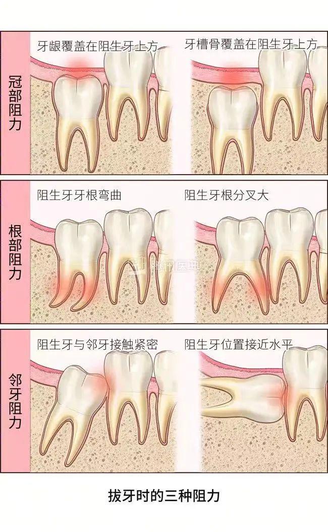 一次性拔掉4颗智齿可以吗？专家建议：谨慎行事