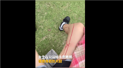 女生被日本小鹿戳破腿 忍痛回国打针